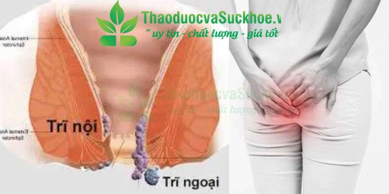 Bệnh trĩ: Nỗi ám ảnh thầm kín và cách đánh bay hiệu quả