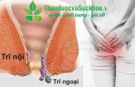 Bệnh trĩ: Nỗi ám ảnh thầm kín và cách đánh bay hiệu quả