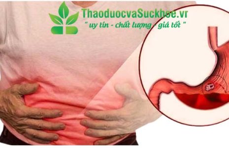 Đau dạ dày: Nguyên nhân, triệu chứng và cách phòng ngừa