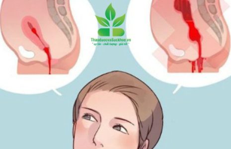 Giải mã rong kinh- băng huyết : Chìa khóa bảo vệ sức khỏe phụ nữ