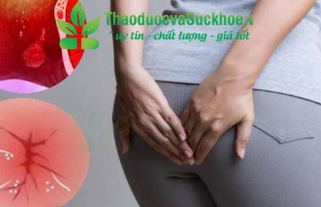 Hiểu rõ về bệnh trĩ: Nguyên nhân, triệu chứng và cách điều trị