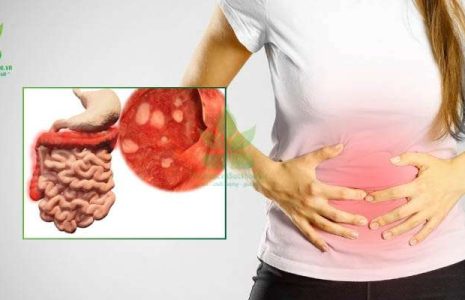 Viêm đại tràng những biến chứng cần cảnh giác, điều trị kịp thời